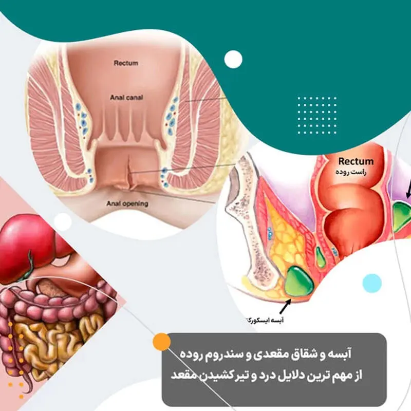 شقاق مقعدی