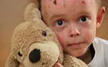 شناسایی 850 کودک "ای‌بی" در کشور/ بی توجهی 26 ماهه وزیر بهداشت به انجمن های بیماری های خاص