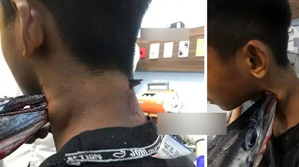 عکس وحشتناک از فرورفتن دهان ماهی نیزه‌ای در گردن نوجوان بوشهری