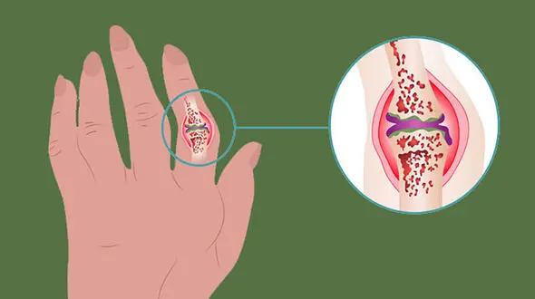 آرتریت چیست؟ / جدول انواع آرتریت و علائم تشدیدکننده آن