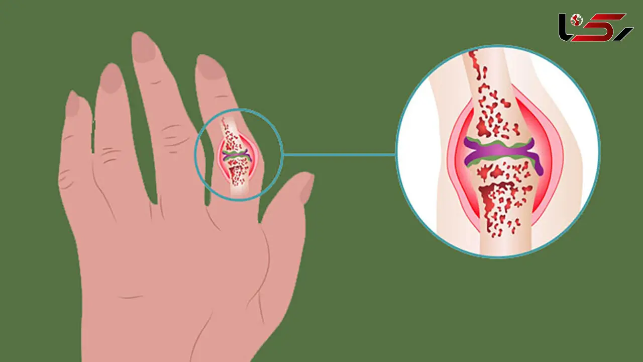 آرتریت چیست؟ / جدول انواع آرتریت و علائم تشدیدکننده آن