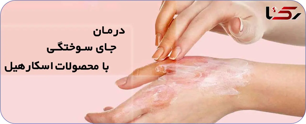 درمان جای سوختگی با محصولات اسکارهیل scar heal