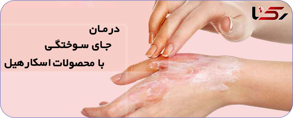 درمان جای سوختگی با محصولات اسکارهیل scar heal