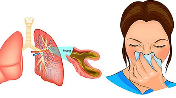 نکات طلایی درباره خلط گلو