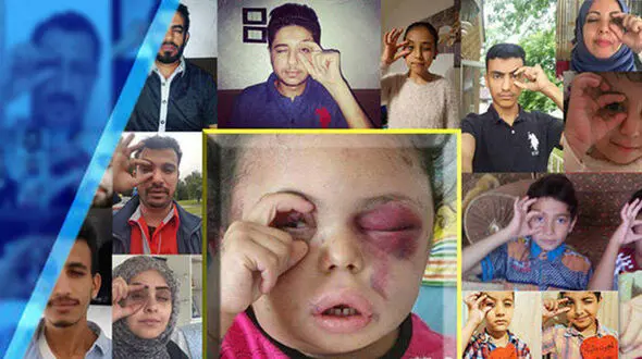 چشم های مظلوم این دختر بچه یمنی دنیا را تکان داد! +فیلم و عکس