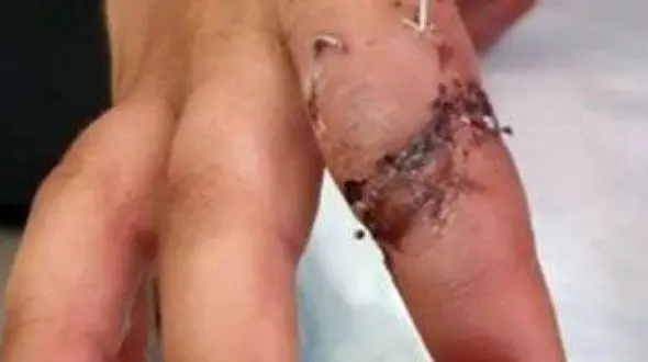 عمل موفقیت آمیز پیوند انگشت دست در بیمارستان گناباد