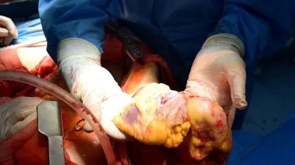 احیای زندگی 4 نفر با اهدای اعضای خانم تبریزی