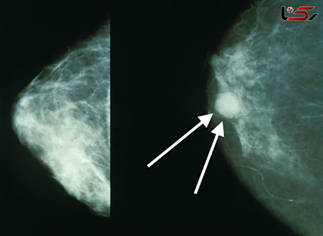 سحرخیزان از «سرطان سینه» در امانند