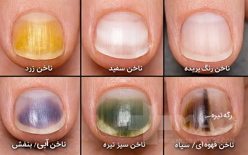 تغییر رنگ ناخن ها از بیماری های ناخن
