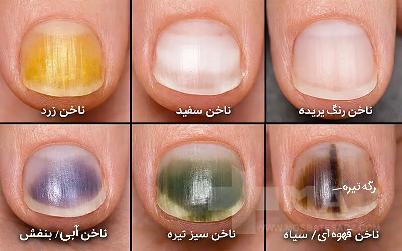تغییر رنگ ناخن ها از بیماری های ناخن