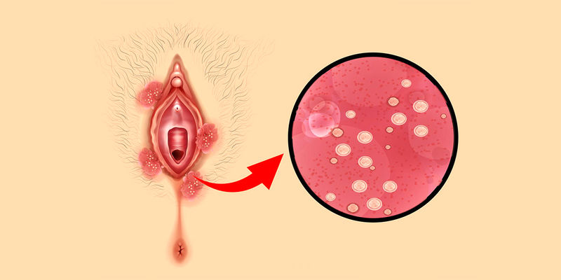 علائم hpv در زنان چیست؟ / راه های پیشگیری از اچ پی وی + جدول