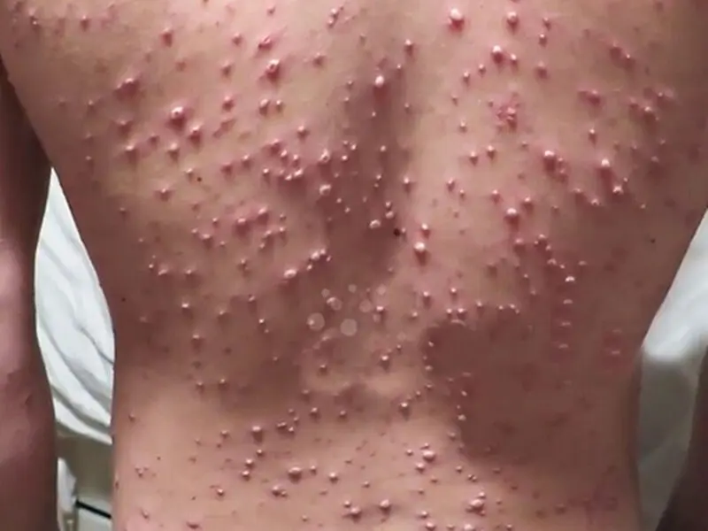 آبله مرغان