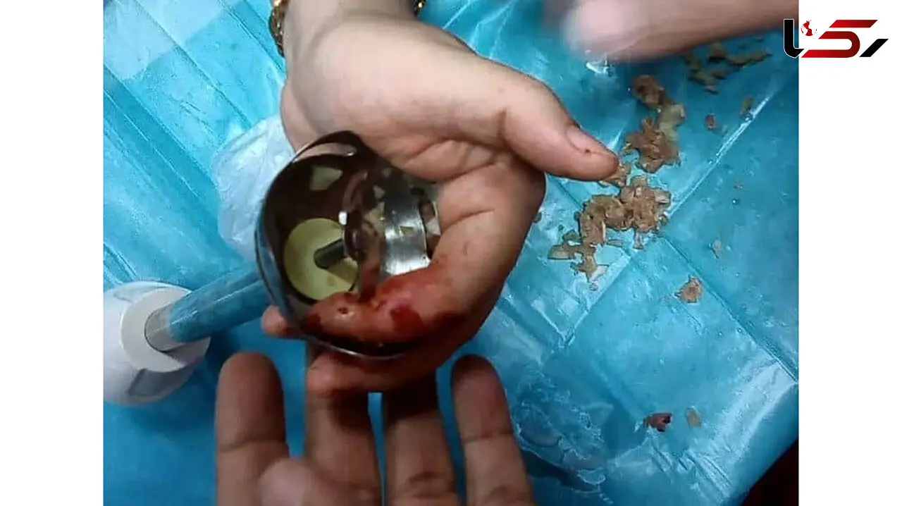 عکس گیر کردن انگشتان زن کاشانی در گوشت کوب برقی
