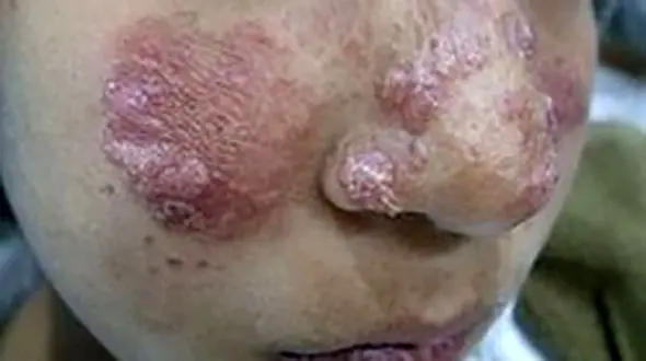 
بیماری سالک بیخ گوش «اسفراینی‌ها»
