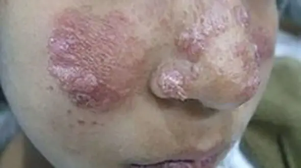 
بیماری سالک بیخ گوش «اسفراینی‌ها»
