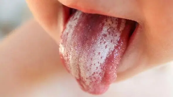 درمان سوختگیِ زبان با راهکارهای خانگی و فوری  