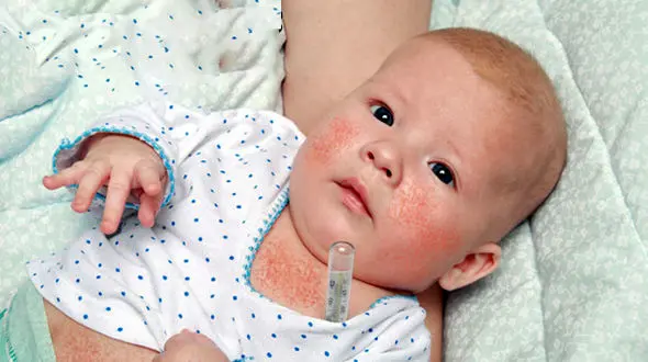 مخملک یک بیماری خطرناک برای نوزادان / علائم مخملک در نوزادان
