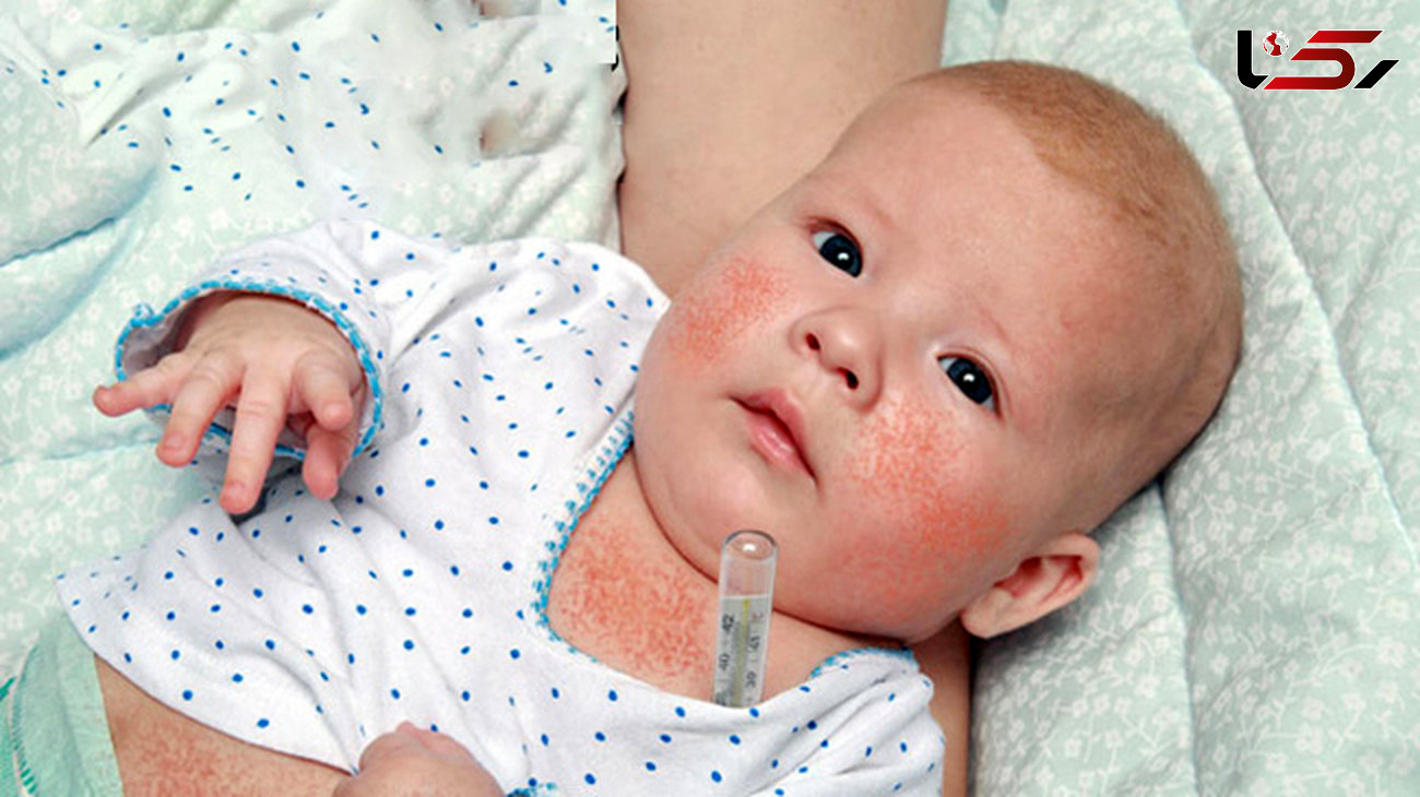 مخملک یک بیماری خطرناک برای نوزادان / علائم مخملک در نوزادان