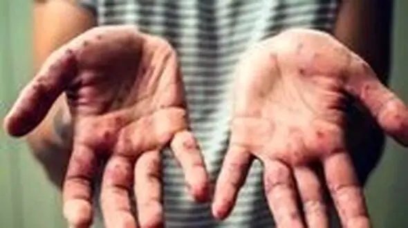 بهبود بیمار مبتلا به آبله‌ میمون در اهواز / مورد جدیدی در ایران شناسایی نشده است