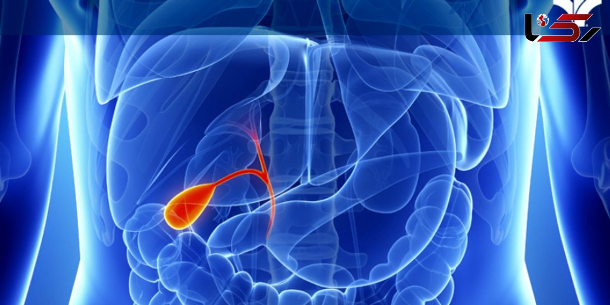 راه های پیشگیری از پر شدن کیسه صفرا