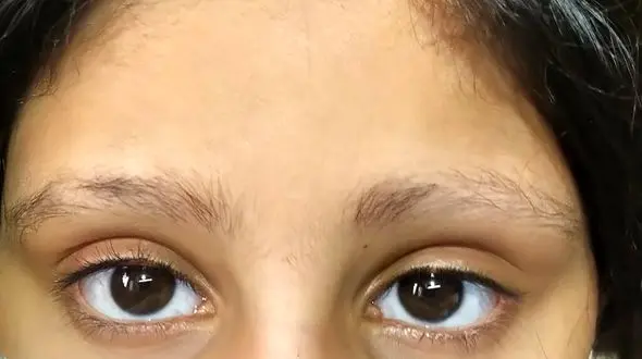 چرا ابروهای مان می ریزد/ راه های درمانی