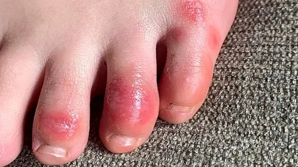 نشانه عجیب از کرونا در پا!