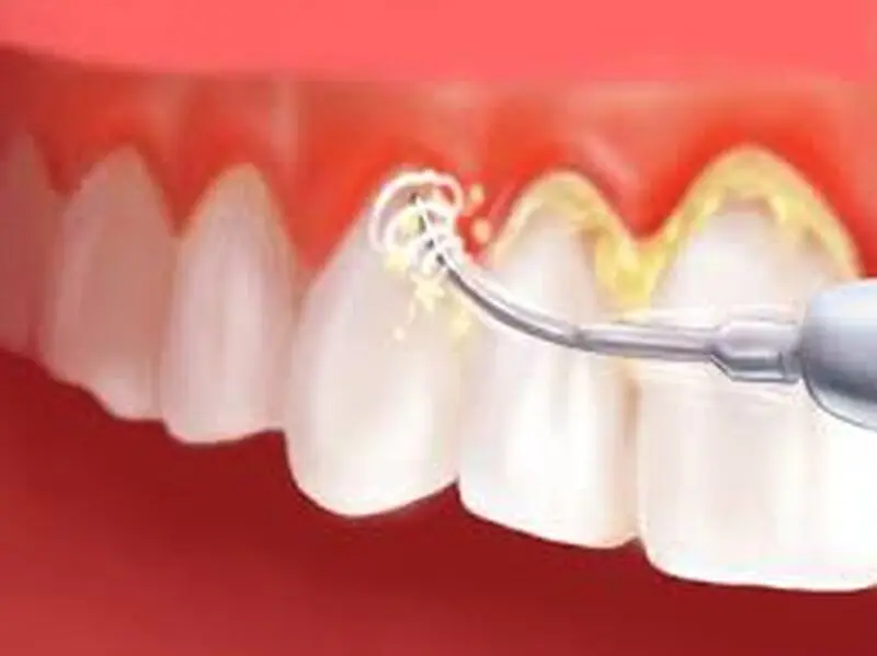 تمیز کردن پلاک دندان