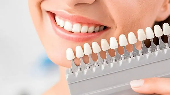 هزینه لمینت دندان در ایران از آمریکا ارزان تر شد!/ جدول هزینه لمینت دندان در سال 1400 در ایران