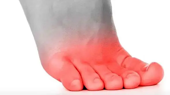 سوزش انگشت پا از چیست؟ / درمان خانگی سوزش انگشت پا