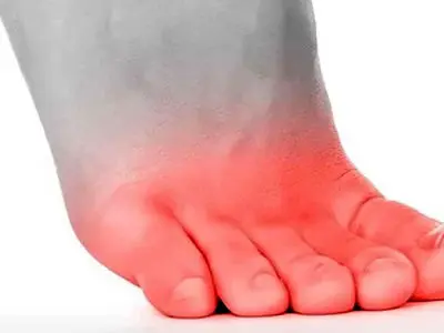 سوزش انگشت پا از چیست؟ / درمان خانگی سوزش انگشت پا