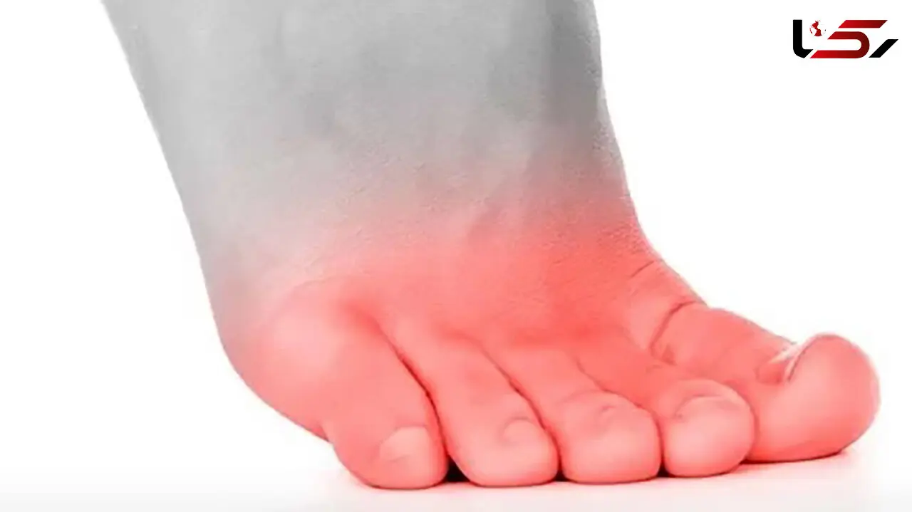 سوزش انگشت پا از چیست؟ / درمان خانگی سوزش انگشت پا