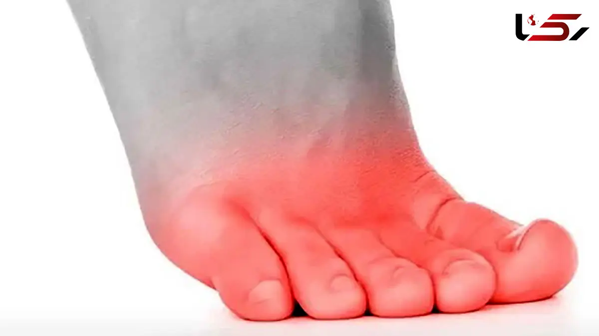 سوزش انگشت پا از چیست؟ / درمان خانگی سوزش انگشت پا