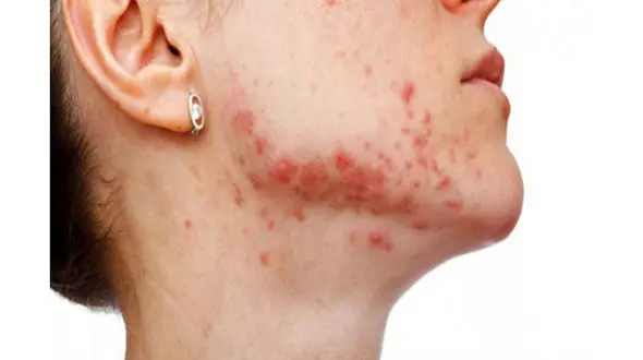 بیماری‌های شایع پوستی تابستان را بشناسید