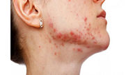 بیماری‌های شایع پوستی تابستان را بشناسید