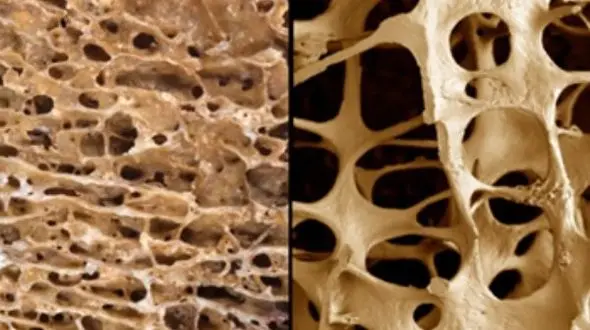 تراشه های ناخن نشانه های ابتلا به بیماری خاموش!