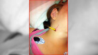 فرو رفتن دردناک یک مداد به گلوی دختر 11 ساله بر اثر بی احتیاطی+عکس