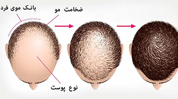 انواع روش های کاشت مو + قیمت