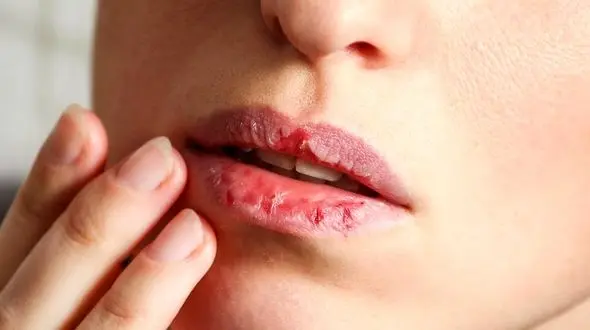 درمان خشکی لب در پاییز