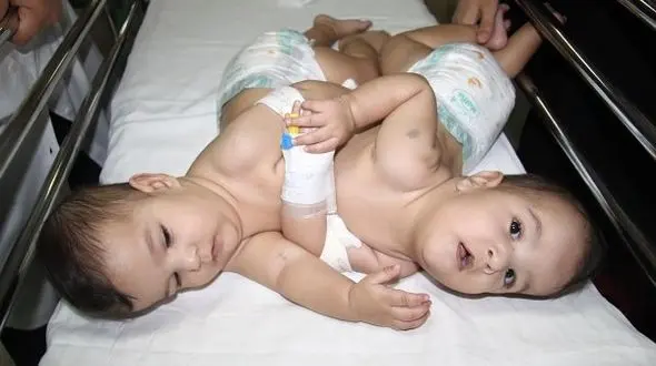 دوقلوهای به هم چسبیده از هم جدا شدند/ در شیراز رخ داد +تصاویر