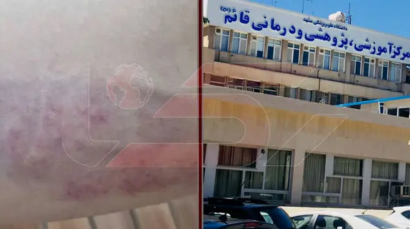 پزشک فوق تخصص مغز و اعصاب زن در  بیمارستان قائم مشهد پرستار را کتک زد! 