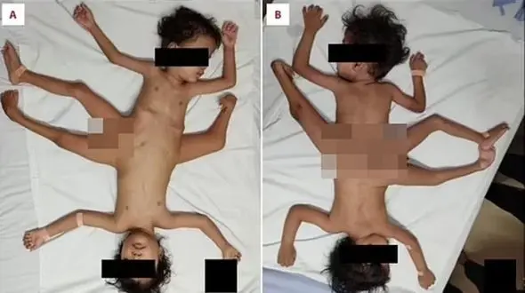 عکس های شوکه کننده از 2 قلوهای عنکبوتی / 3 پا و 4 دست دارند!