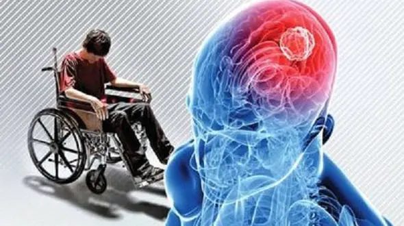 یک راه جدید برای درمان ام اس