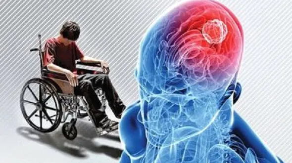 یک راه جدید برای درمان ام اس