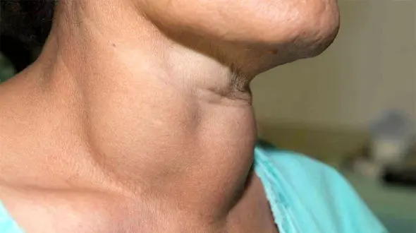 تیروئید شما در خطر است / سرطان ممکن است خاموش رشد کند !