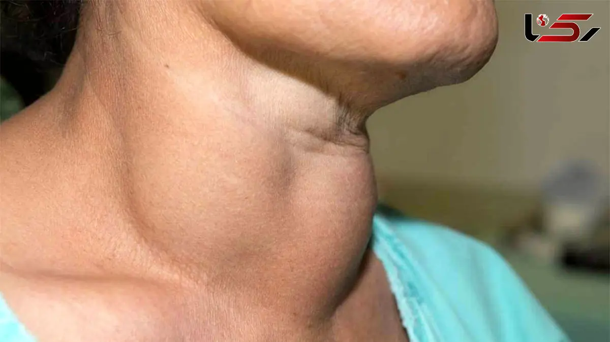 تیروئید شما در خطر است / سرطان ممکن است خاموش رشد کند !