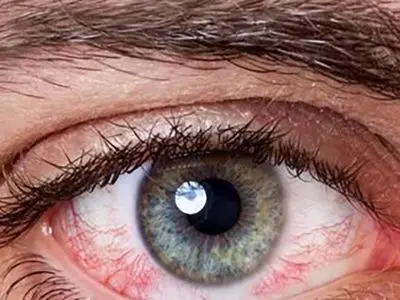 توصیه هایی برای سلامت چشم ها