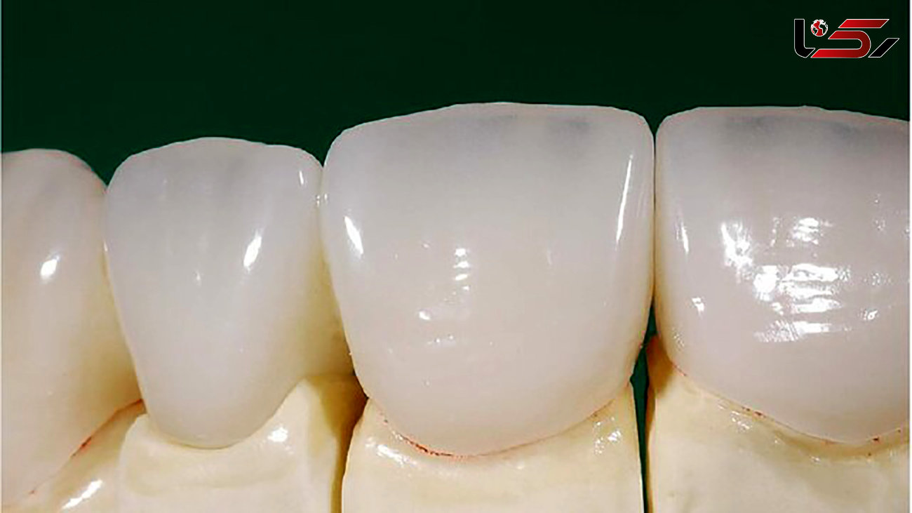 دندان های ایرانی ها سرامیکی می شود