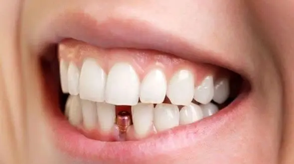 ایمپلنت دندان: نکات کلیدی و بایدها و نبایدها