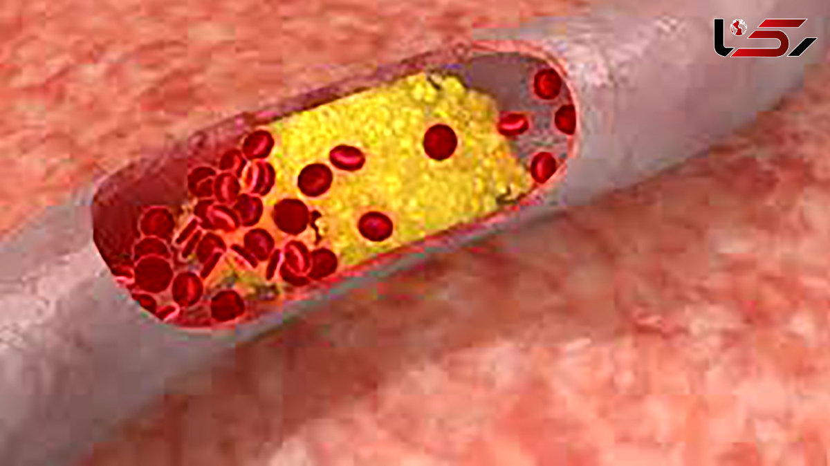 هشدارهای جدی کلسترول خون بالا