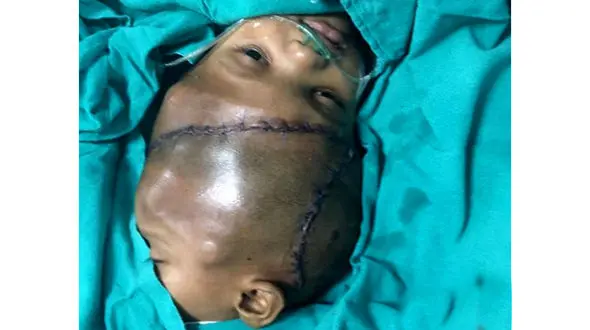  ۱۶ ساعت جراحی جداسازی دوقلو‌های از سر به هم چسبیده + تصاویر 